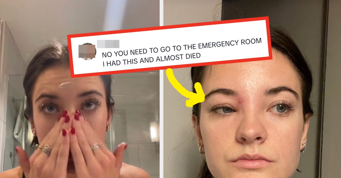 Brooke Hyland From “Dance Moms” Popped A Pimple On Her Face’s “Triangle Of Death” — Which She Didn’t Know Could Lead To Brain Infection — And Now She’s Warning Others